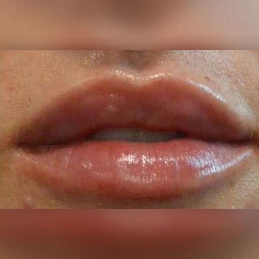 Lip fillers can improve the appearance and symmetry of your lips