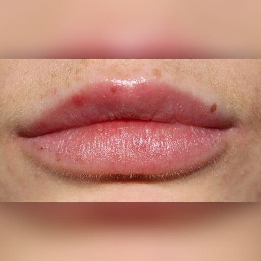 Lip enhancement can boost your confidence and self-esteem